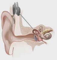 cirurgia de implante coclear